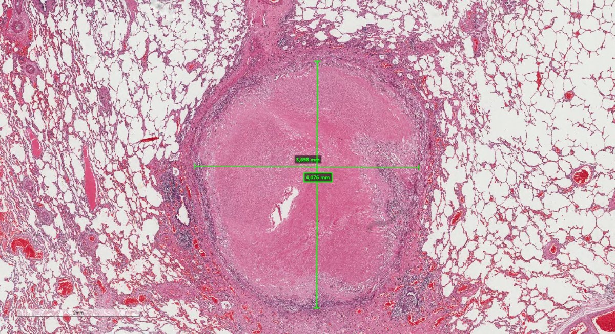 Necrose Pulmonar